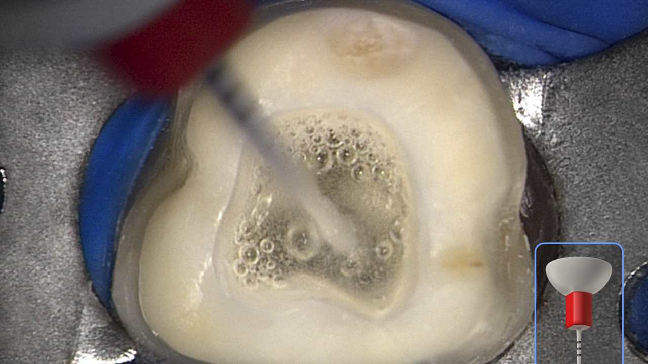 1. This clinical image shows the SLP EndoActivator in use. Note the powerful activation of fluid and appreciate the suborifice potential for 3D cleanin