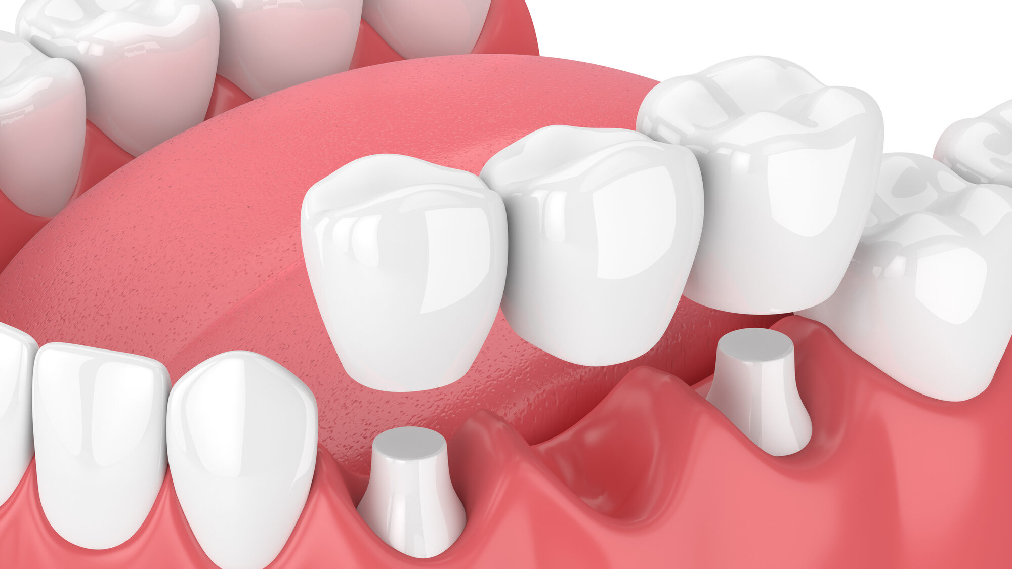 3d render of jaw with dental bridge alternate text for this image