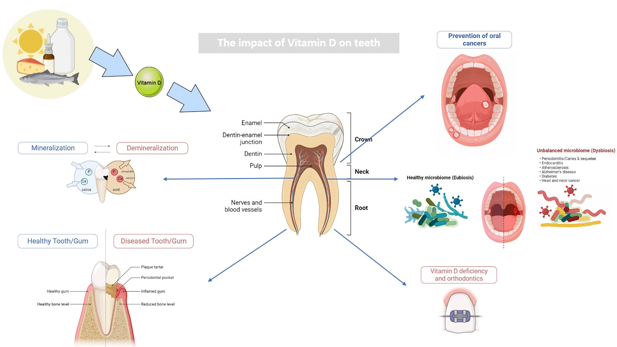 . By contrasting a tooth surrounded by healthy, light-colored gums with a tooth surrounded by diseased gums, this picture demonstrates how dietary vitamin D influences dental health. By facilitating calcium absorption, dietary vitamin D, represented by a food symbol, affects dental health. This promotes stronger teeth and supports overall dental health by strengthening tooth structure. The illustration also shows the potential prevention of oral cancer, maintenance of a healthy oral microbiome, and faster bone formation during orthodontic treatment.