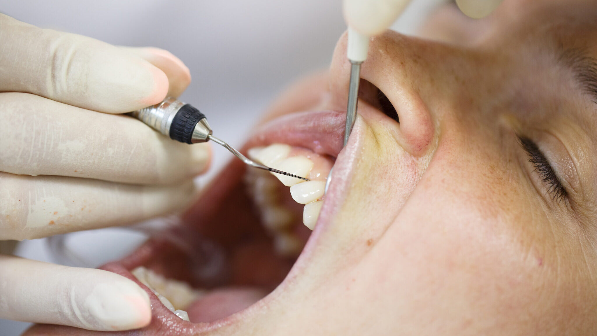 Periodontal probe for measuring pocket depths alternate text for this image