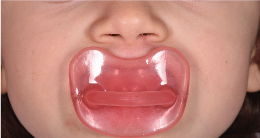 Patient using the Pediatric BioActivaotr DC as a “new pacifier”.