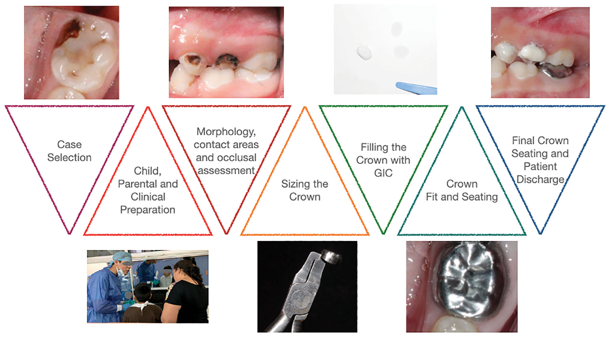 Step-by-step of the Clinical Hall Technique Procedure.