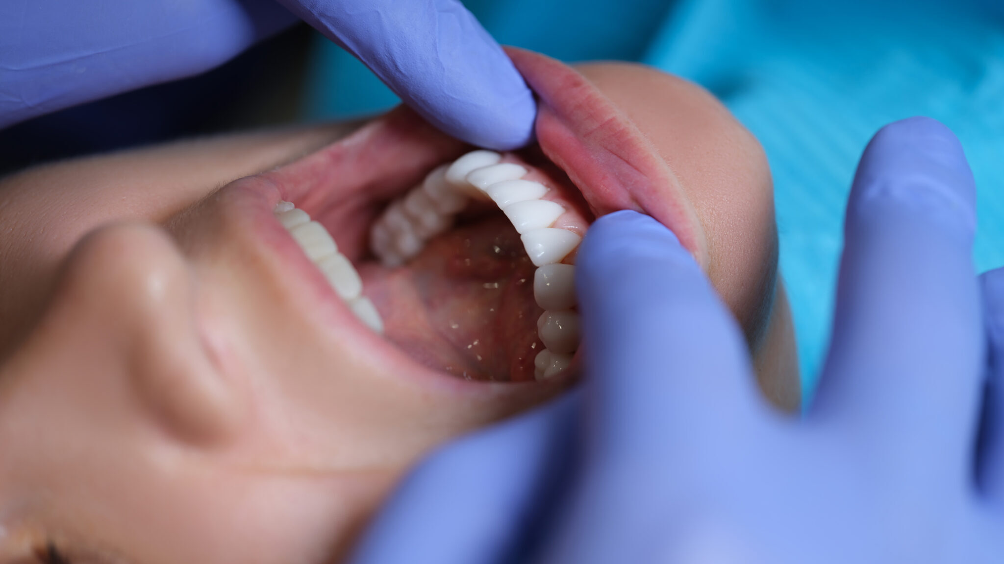 Doctor dentist examining patient oral cavity with veneers closeup alternate text for this image