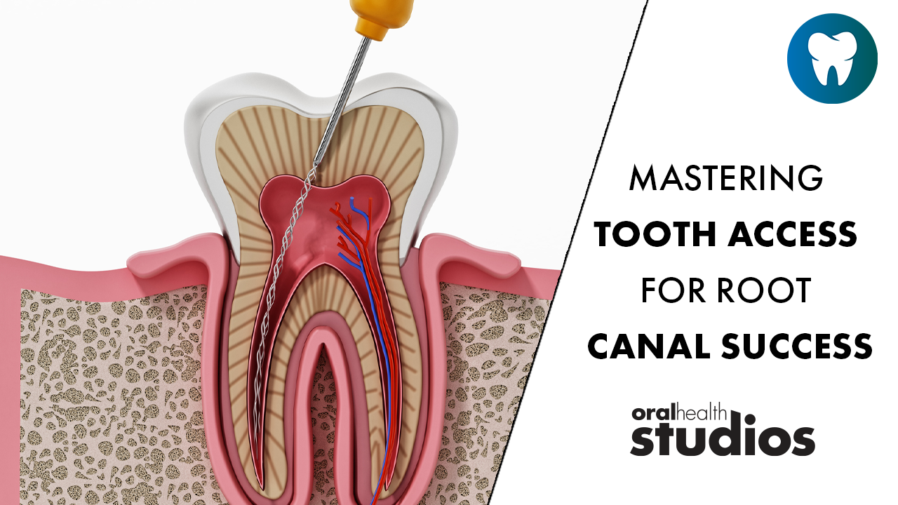 Mastering-Tooth-Access-for-Root-Canal-Success alternate text for this image