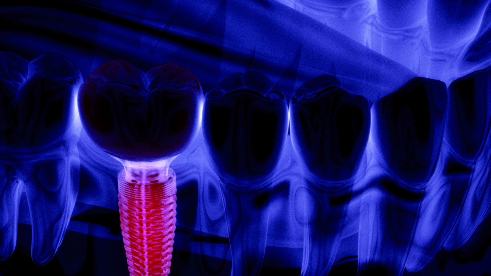 Titanium is the most commonly used material in dental implants due to its biocompatibility and durability.