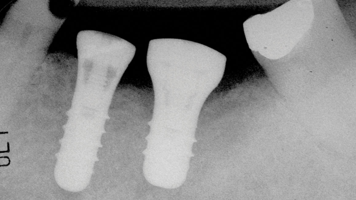 Spontaneous-resolution-advanced-peri-implantitis alternate text for this image