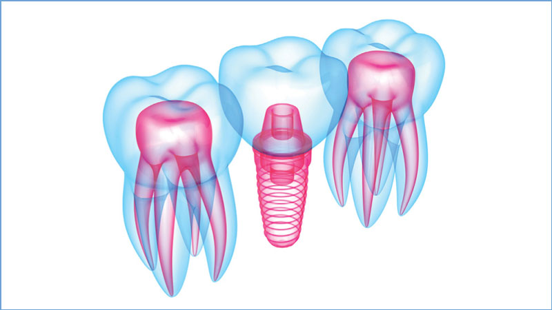 Dental implants