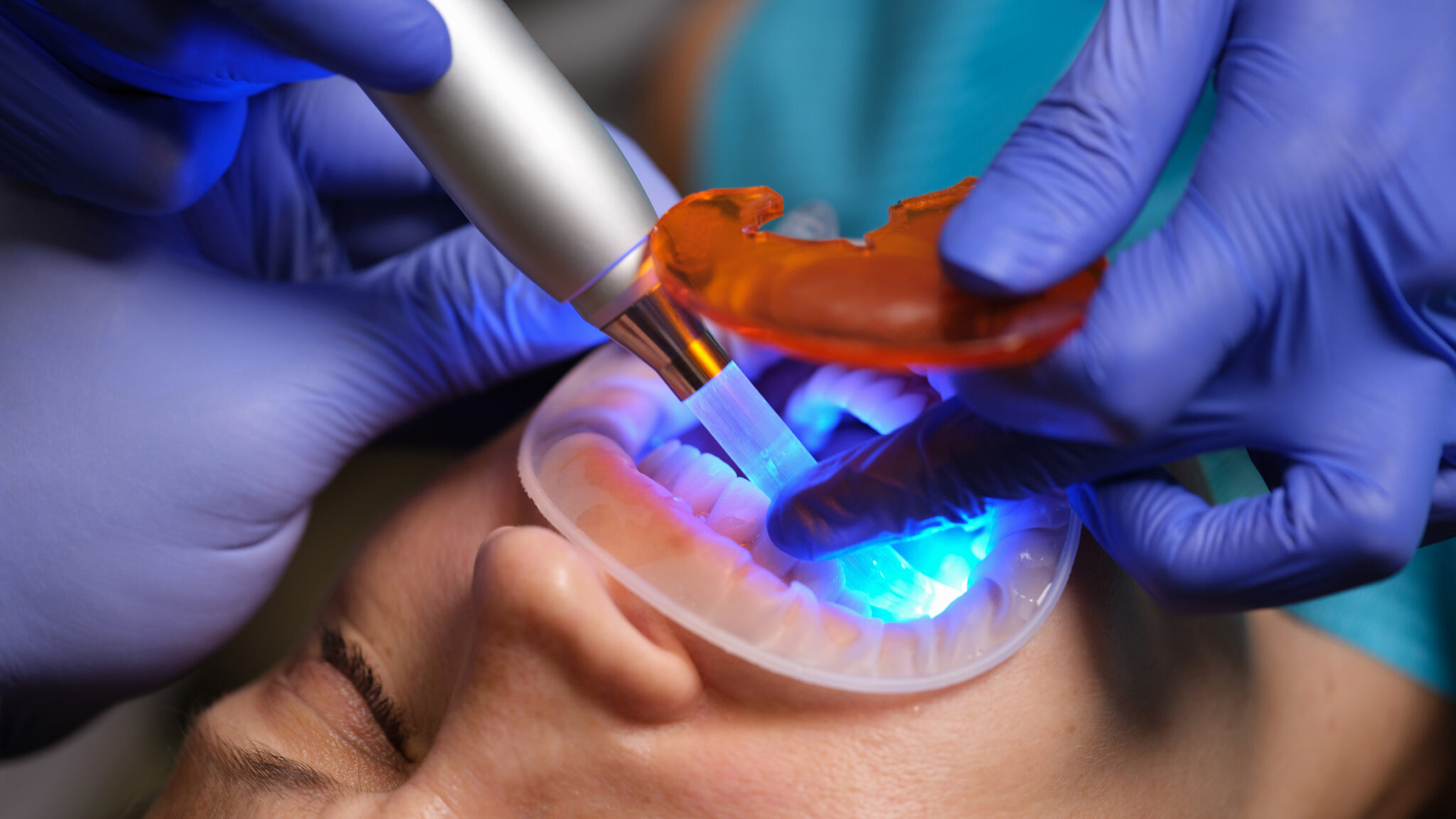 Restoration of teeth with filling-polymerization lamp alternate text for this image