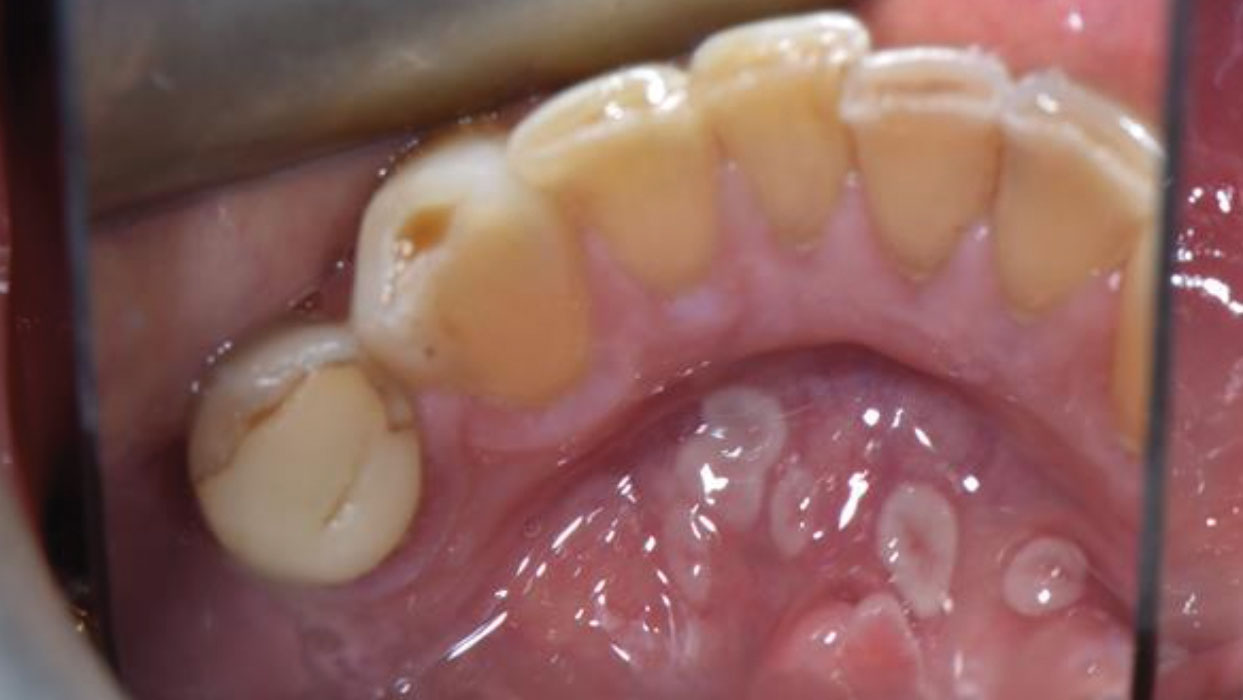 Geographic-tongue-rosenboom alternate text for this image